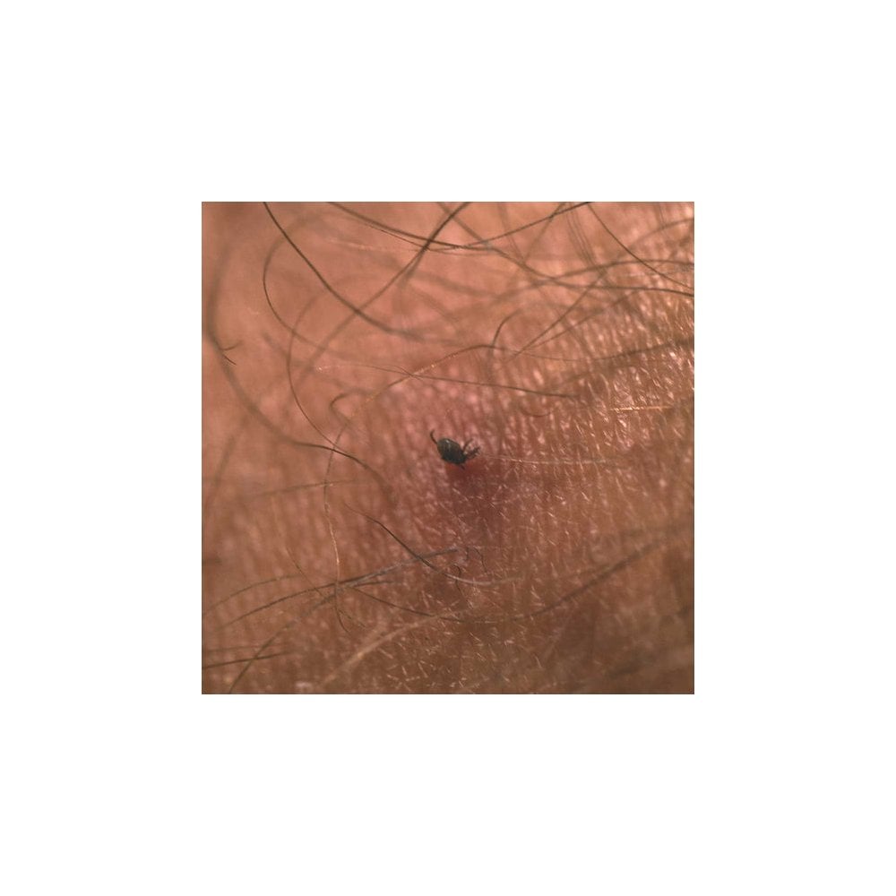 Tick Remover Card MRK 339